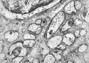 M, 58y. | neurofibroma